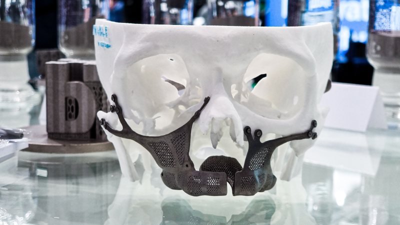 Beispiel einer Legierung, bestehend aus Titan, Niobium und Tantal, in einem CMF-Implantat (Bild: Tanobis).